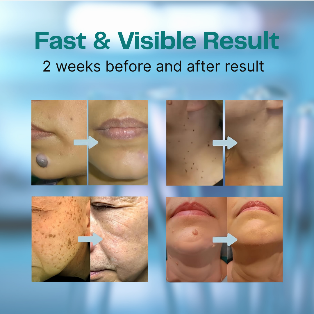 Non-Invasive Mole and Wart Removal Laser Pen