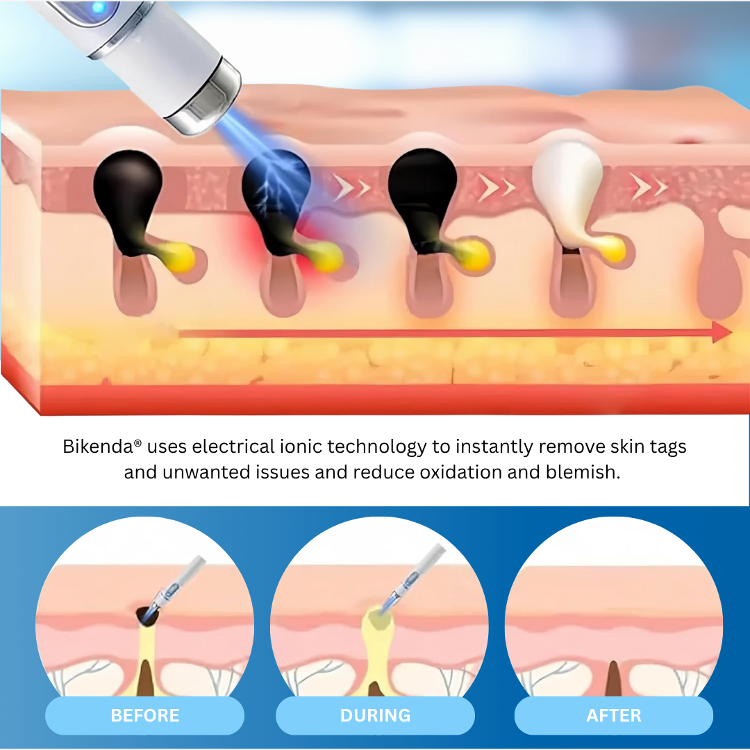 Non-Invasive Mole and Wart Removal Laser Pen